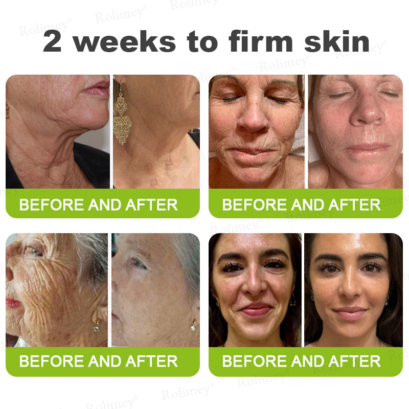 💫👨‍⚕️Made and shipped from the UK 💫Rolimey® Botox & Vita-A Retinol Shot Wrinkle-Lift Tightening cream - Last Day Promotion 70% OFF