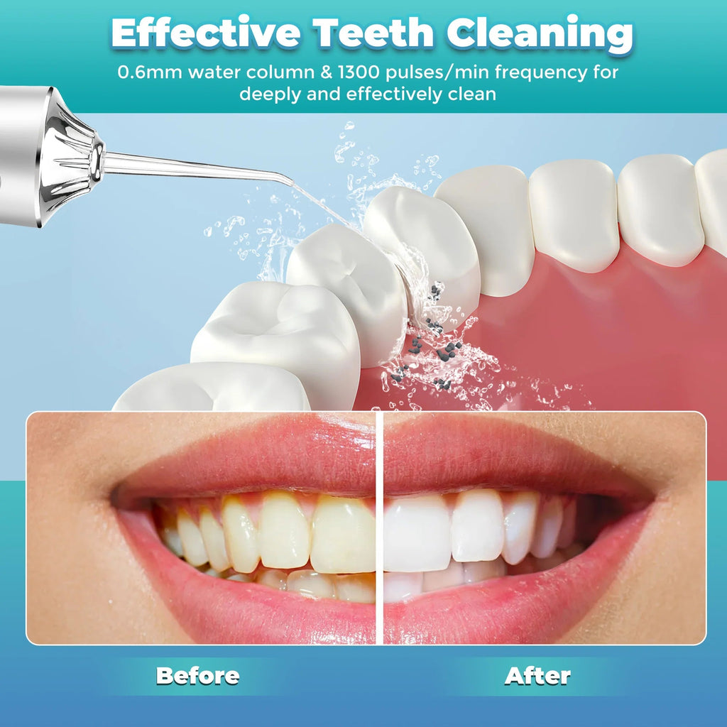 Cordless Oral Irrigator – 4 Tips