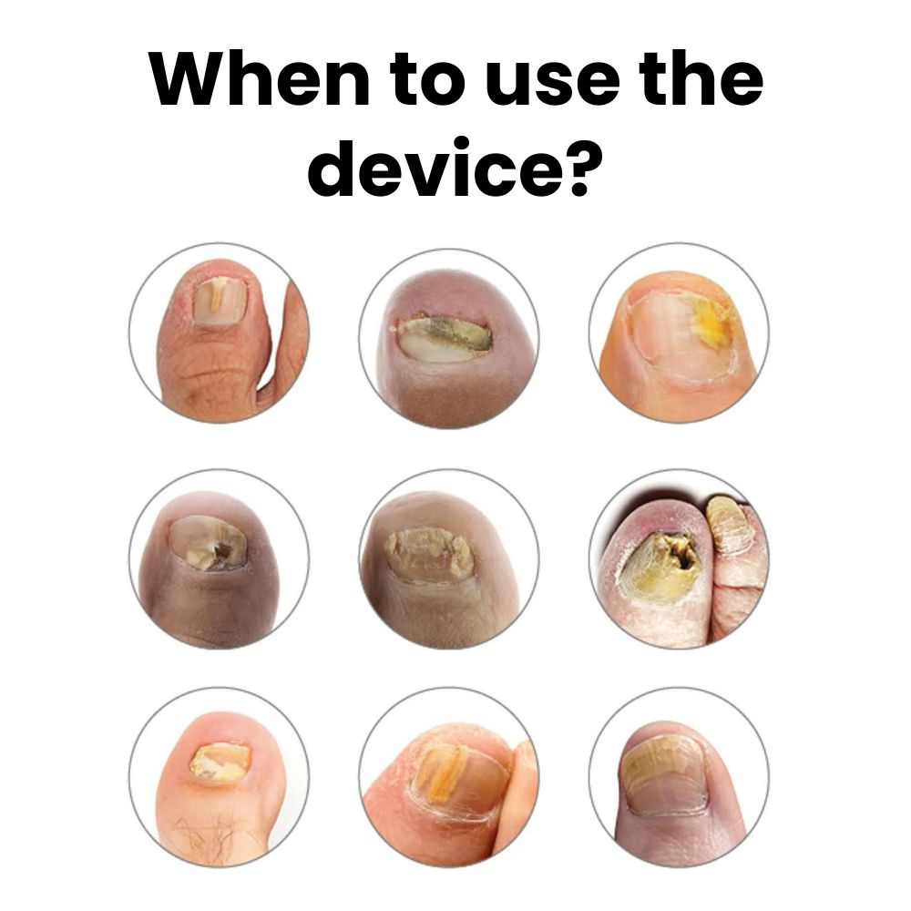 Nail Fungus Cleaning Laser Device