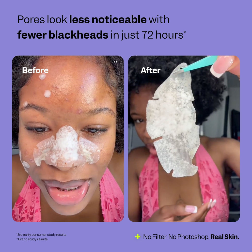 NOSE PATCHES